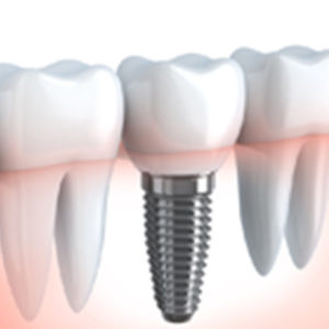 Dental implants in gloucester