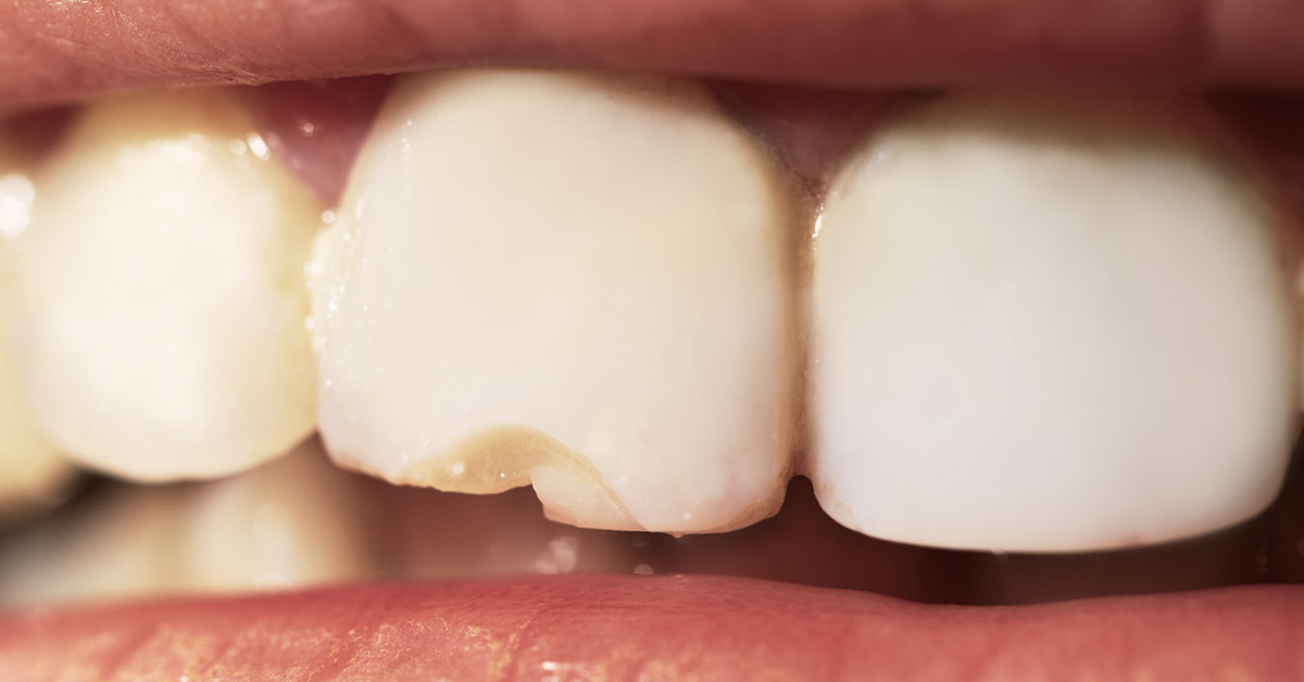Dealing with minor dental issues during CoVid19 UK lockdown