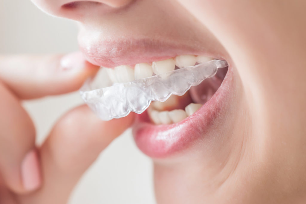 Invisalign 1024x684