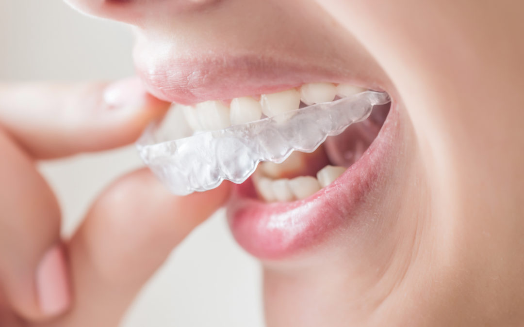 Invisalign FAQ: All you need to know about Invisalign aligners