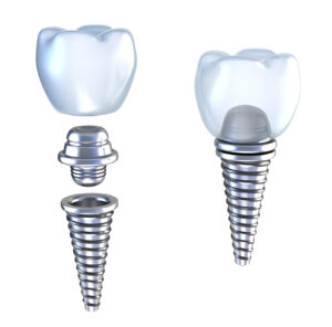 Bigstock Dental Implant D Crown With P 14220674 300x296