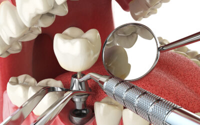 Restore Your Smile with Dental Implants at Cotteswold House Dental Care