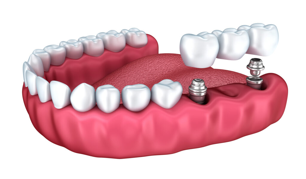 3d lower teeth and dental implant isolated on white